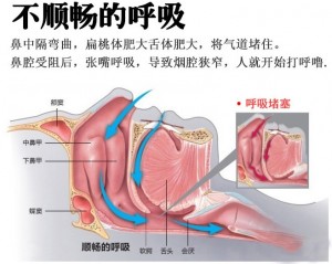 家用呼吸机帮助我们顺畅呼吸